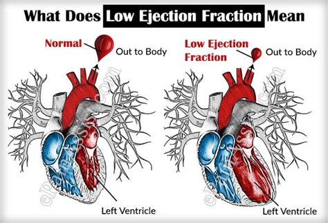 low normal lv systolic function|what causes low ejection fraction.